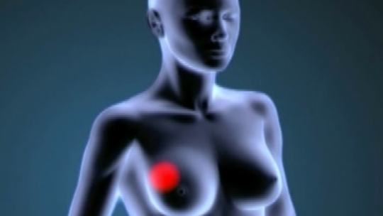 Aún habiendo una gran variedad de agentes antitumorales, muchos tratamientos fallan con el tiempo para tumores sólidos en estadio avanzado, incluído el cáncer de mama.