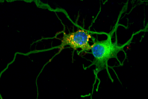 Confocal microscopy image. The accumulation of glycogen (yellow and red) in neurons leads to their deterioration and finally death (IRB Barcelona)