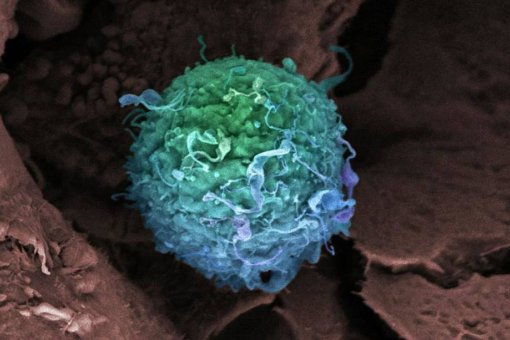 Una célula de cáncer de mama. Imagen: GETTY, El País.