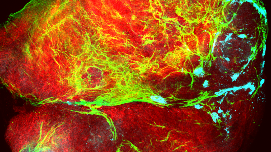Tumor (rojo) cubierto por colágeno (verde) que está siendo depositado por células del sistema inmune (cian). (Imagen: Mariana Muzzopappa, IRB Barcelona)