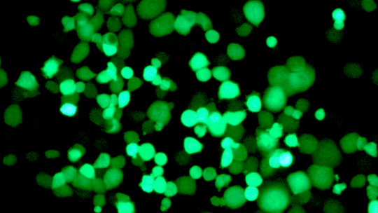 Células tumorales infectadas por el virus, que expresa una proteína fluorescente. A medida que pasan los días (quinto día en la imagen), el virus se multiplica, genera nuevos viriones que infectan más células cancerígenas.(IDIBAPS, IRB Barcelona)